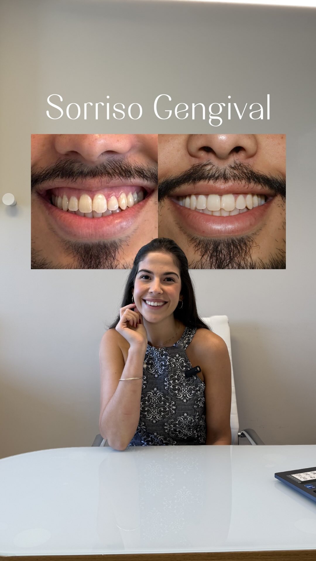 Sorriso gengival - antes e depois