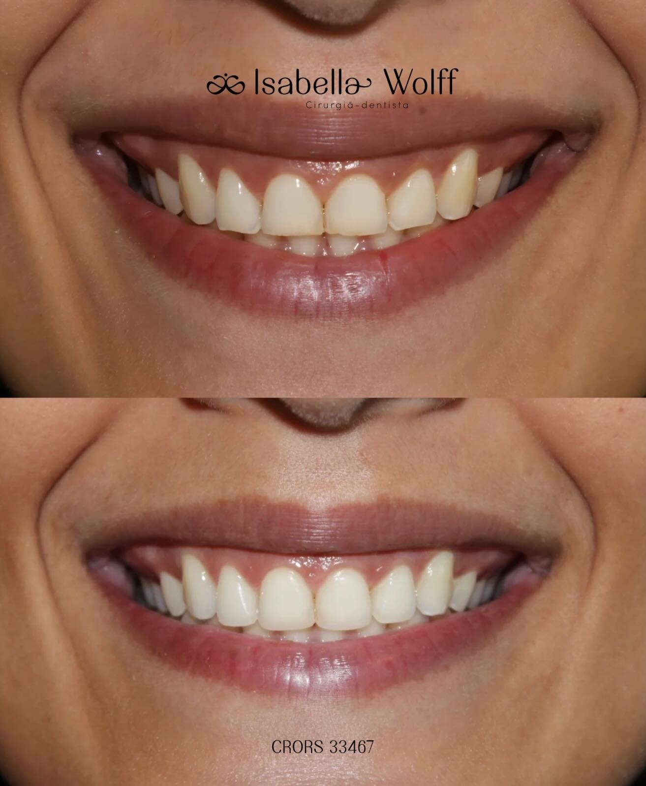 Harmonização do sorriso