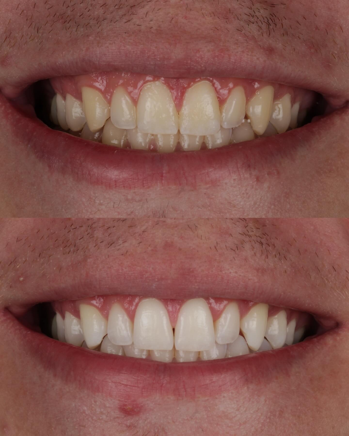 Clareamento e estética
