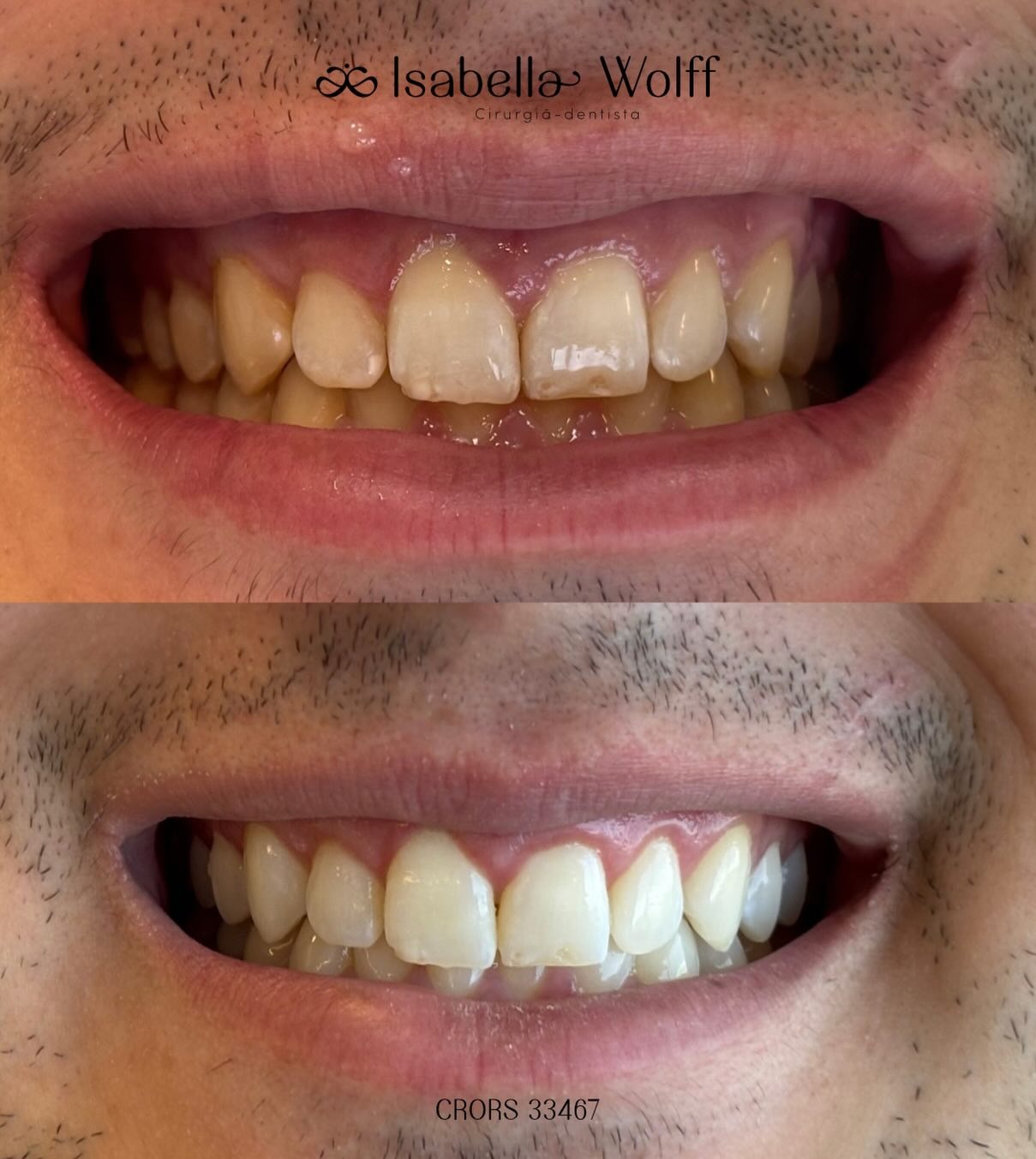 Antes e depois - tratamento estético